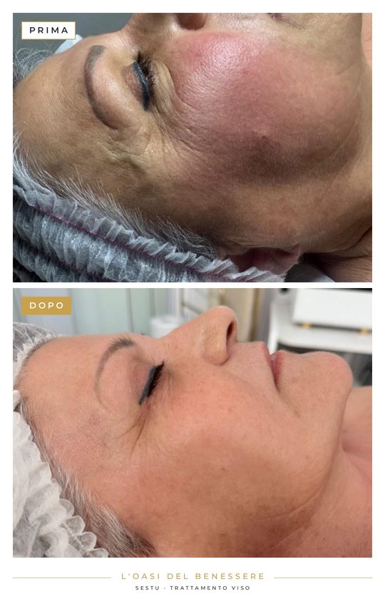 Trattamento viso all’Oasi del Benessere, foto 3 di 5: in alto prima, in basso dopo